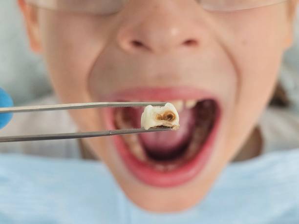 Best Emergency Dental Filling Replacement  in Redby, MN